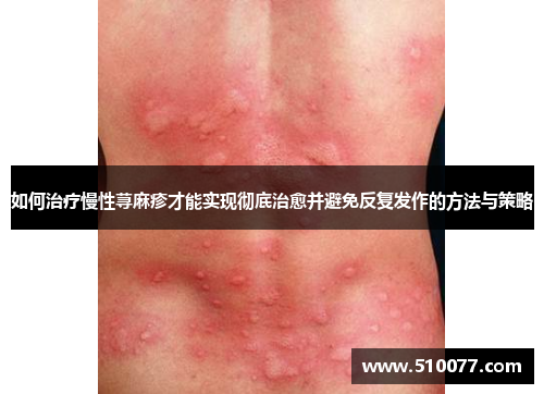 如何治疗慢性荨麻疹才能实现彻底治愈并避免反复发作的方法与策略