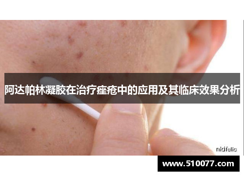 阿达帕林凝胶在治疗痤疮中的应用及其临床效果分析