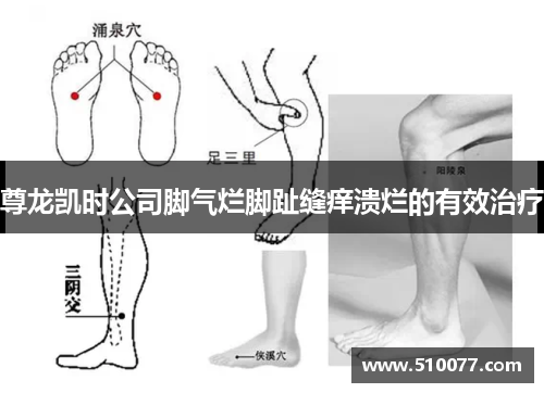 尊龙凯时公司脚气烂脚趾缝痒溃烂的有效治疗